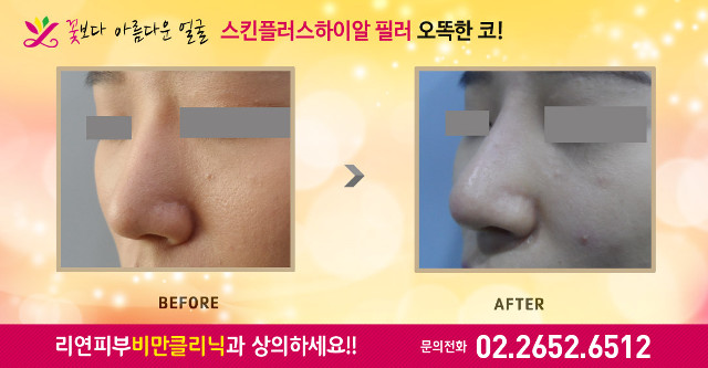 리연클리닉 메부리코 코필러 전후사진
