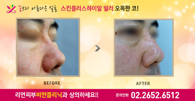 리연클리닉 스킨플러스하이알 코필러 전후사진