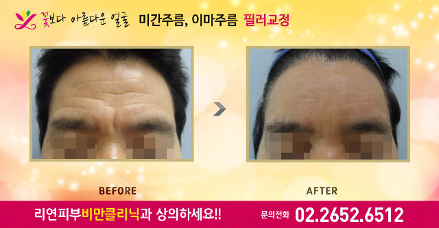 리연클리닉 이마필러 전후사진