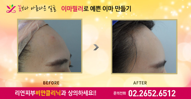 리연클리닉 이마필러 전후사진