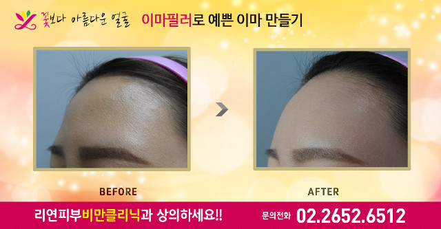 리연의원 코필러 바비코 전후사진