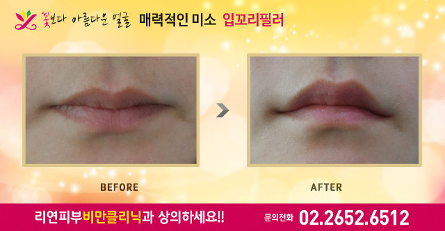 리연의원 입꼬리필러 전후사진