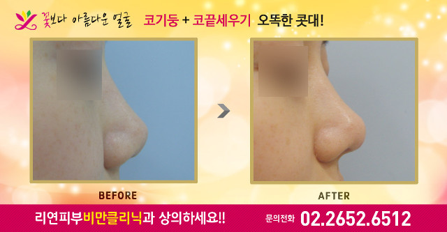 리연의원 코필러 바비코 전후사진