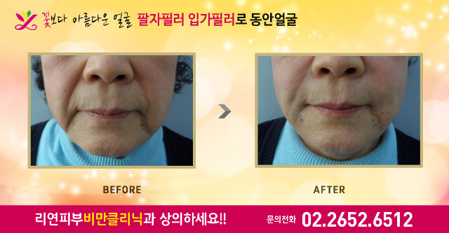 리연클리닉 팔자필러 전후사진