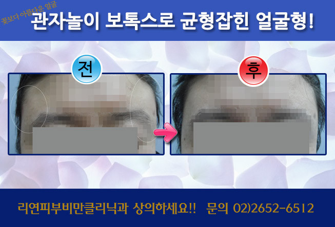 관자놀이보톡스 전후사진