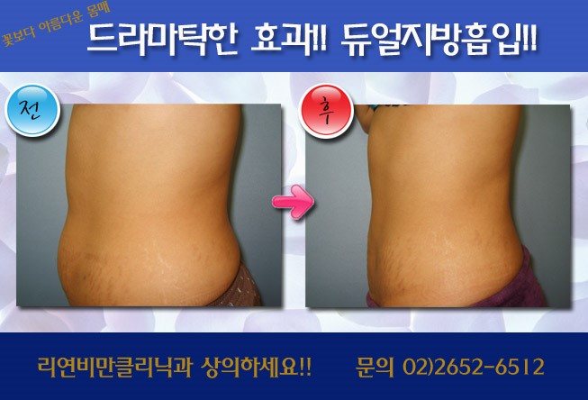 리연클리닉 지방흡입