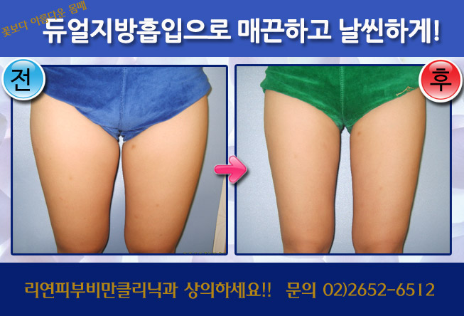 리연클리닉 지방흡입 전후사진