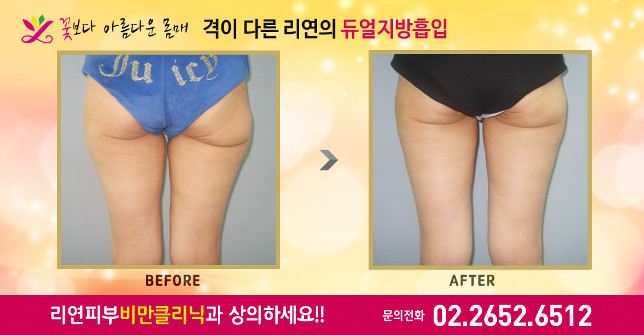 리연클리닉 바비코성형 전후사진